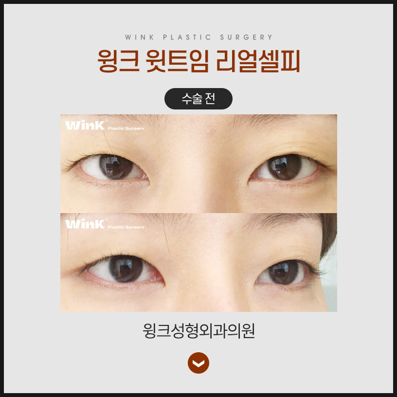 트임성형 윗트임으로 전체적으로 눈을 시원하게! 관련 이미지 6
