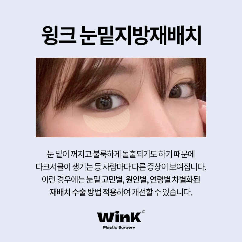 윙크성형외과 눈밑지방재배치 생기넘치고 어려보이게 관련 이미지 2