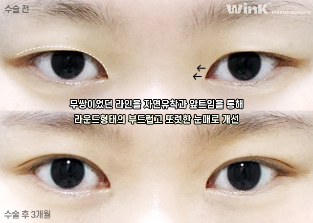 I Would Like to Talk About Natural Adhesion Double Eyelid Surgery. image 4