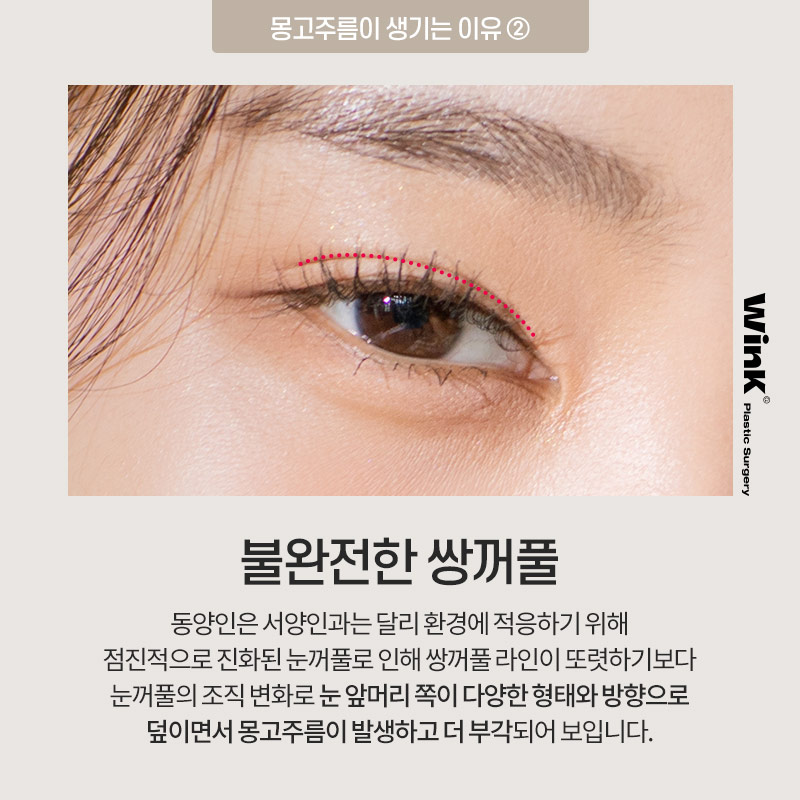 몽고주름이 쌍꺼풀 수술에 미치는 영향! 윙크성형외과에서 알려드려요 관련 이미지 4
