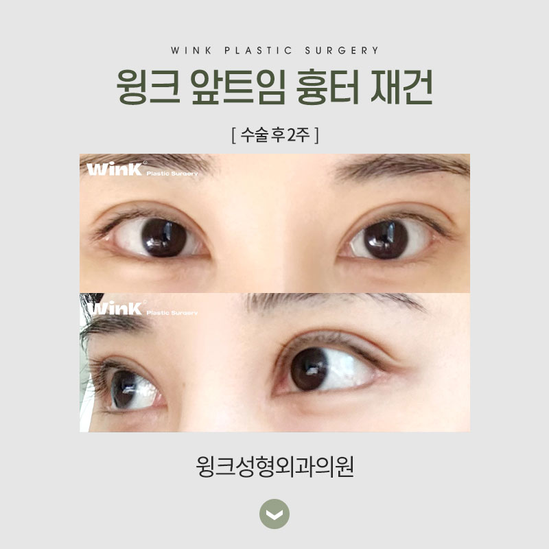 앞트임 흉 재건에 대해 알아보겠습니다. 관련 이미지 5