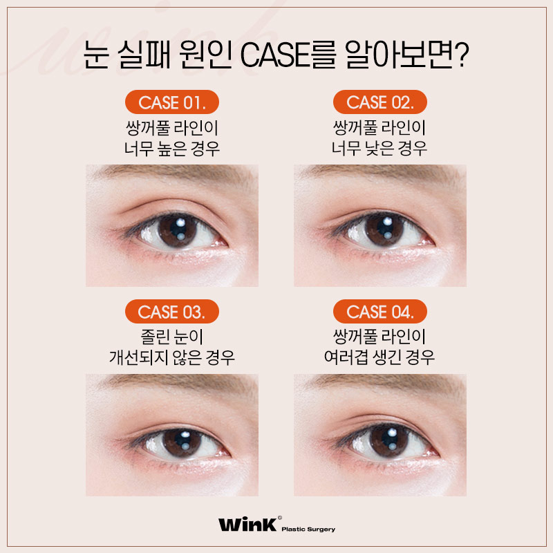 Wink Plastic Surgery Double Eyelid Revision Surgery, Pursuing Natural Results by Identifying the Exact Cause of Failure image 2