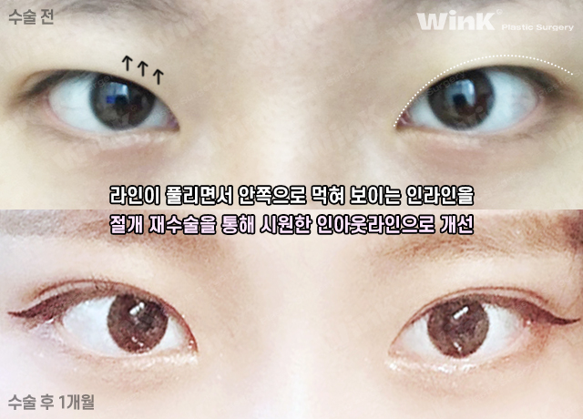 If You’re Looking Into Revision Double Eyelid Surgery, Visit Wink Plastic Surgery for Beauty and Function! image 4