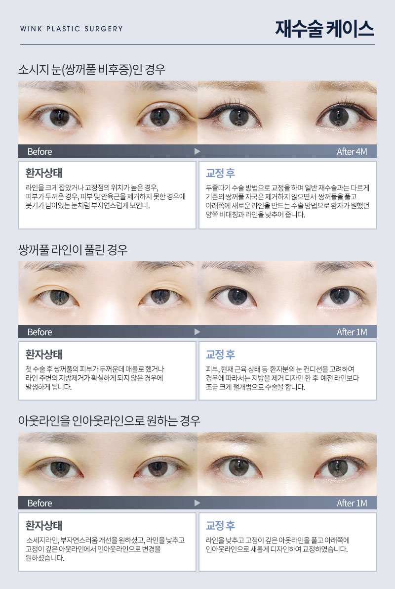 오직 눈 성형만 연구한 눈수술, 눈재수술 명의 윙크성형외과 최승협 대표원장님 관련 이미지 8