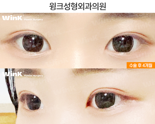 중학생 쌍커풀수술에 대해 알아볼까요? 관련 이미지 4