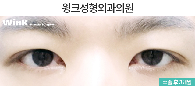 남자 자연유착 쌍꺼풀에 관해 알아볼까요? 관련 이미지 3