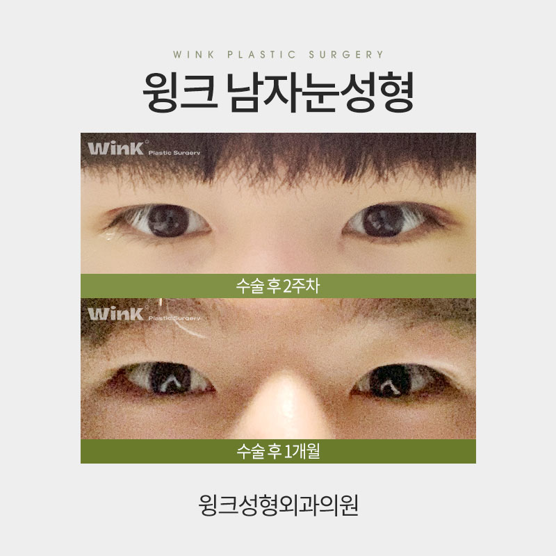 Male Eye Surgery: How Is It Best Done? image 6