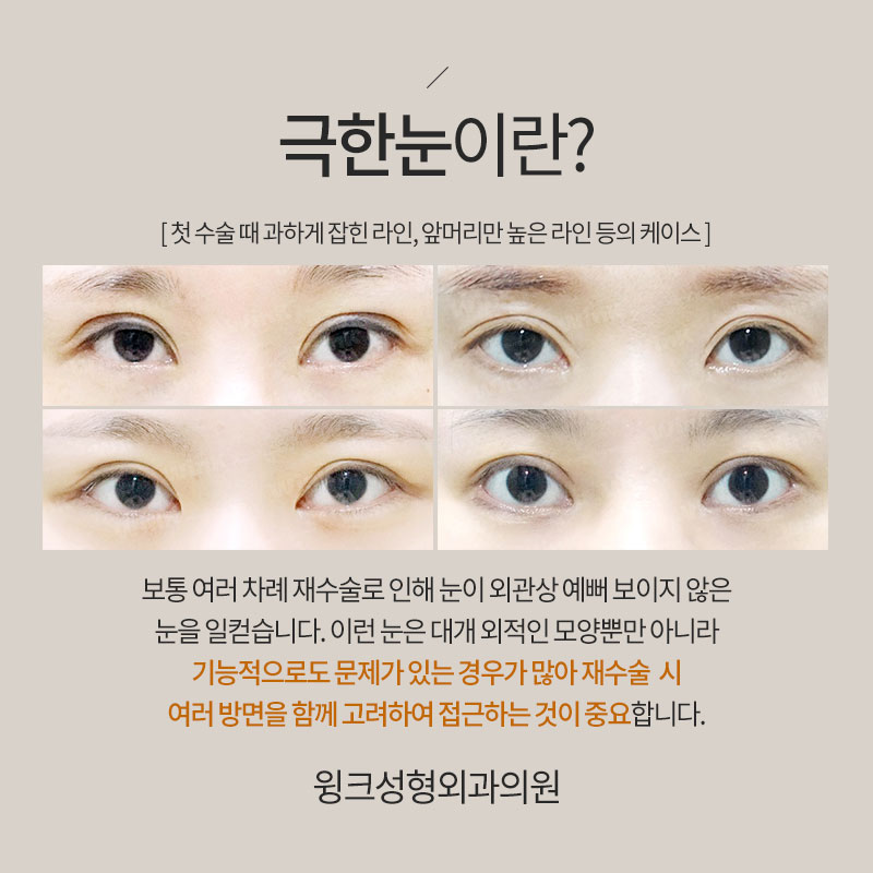 Let’s Learn About Revision Surgery for Severe Eyes? image 2