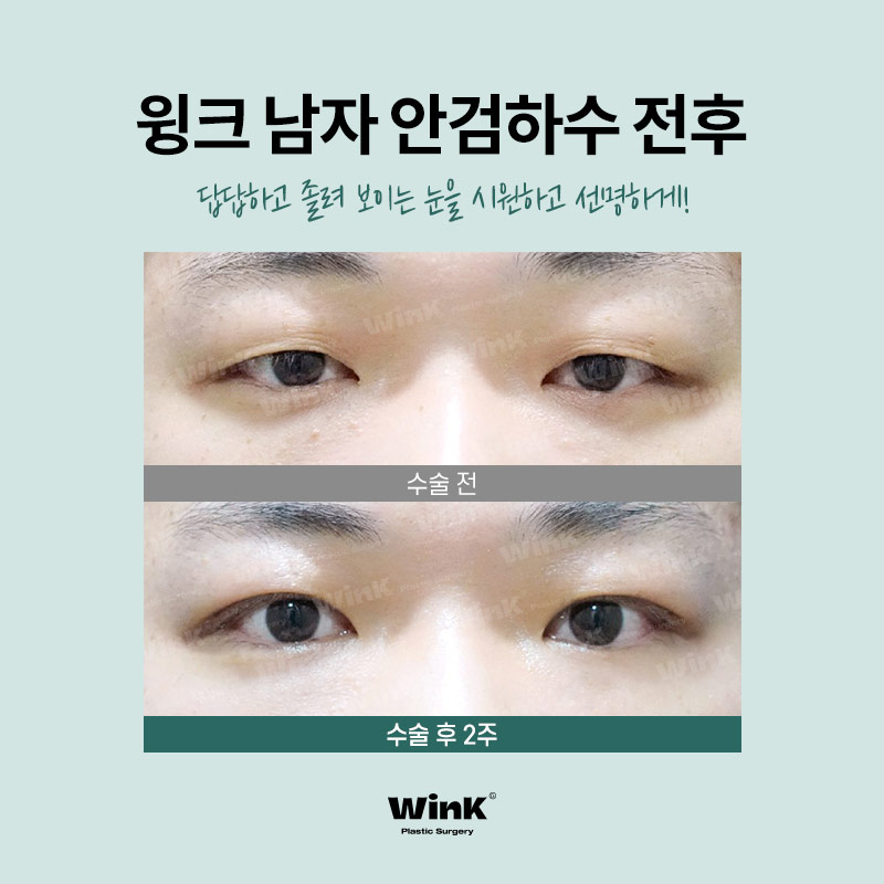 남자안검하수후기 안검하수교정 윙크성형외과 남자눈매교정수술전후 관련 이미지 6