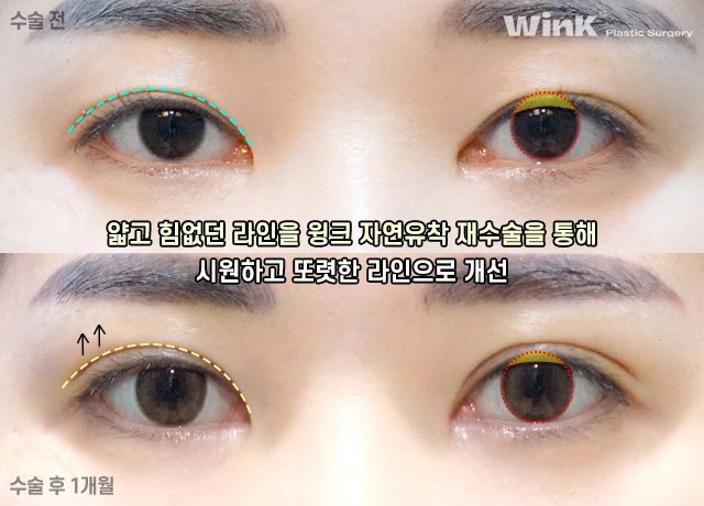 윙크 자연유착재수술로 자연스럽고 확실한 고정! 관련 이미지 7