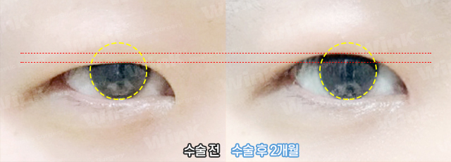 Does He Look Sleepy Because of Ptosis? At Wink Plastic Surgery, Get a Natural and Refreshed Eye Shape! image 8