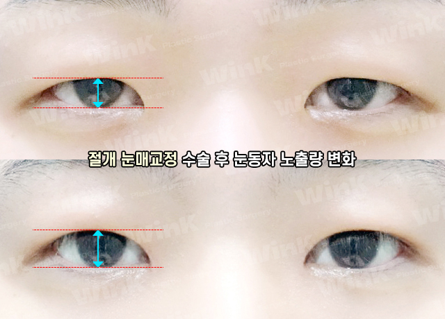 Does He Look Sleepy Because of Ptosis? At Wink Plastic Surgery, Get a Natural and Refreshed Eye Shape! image 6