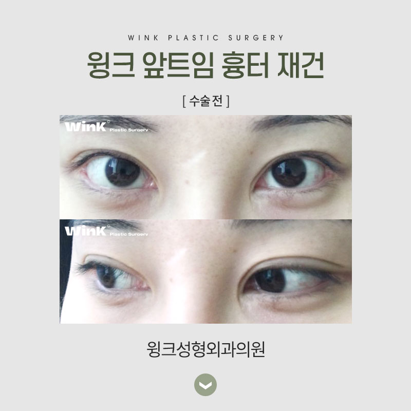 앞트임 흉 재건에 대해 알아보겠습니다. 관련 이미지 4