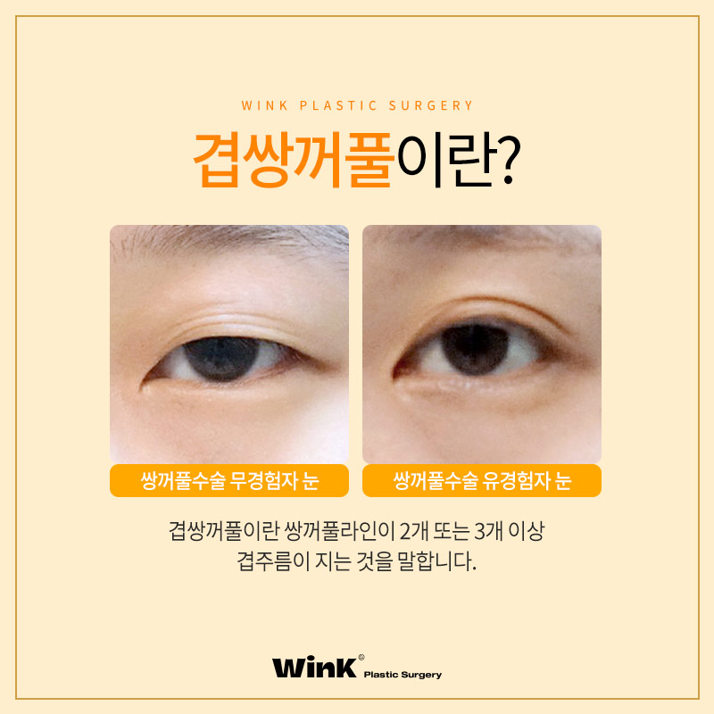 Can Double-Eyelid Surgery Be Done for Double-Fold Eyelids? Wink Plastic Surgery Explains! image 2