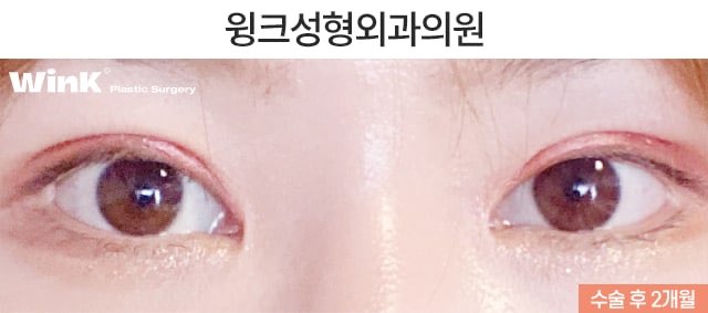 듀얼트임으로 자연스럽게 눈을 키우는 방법에 대해 알아볼까요? 관련 이미지 6