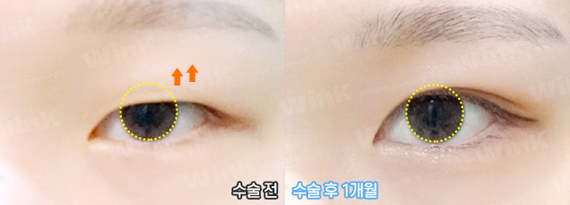 The Key to Ptosis Correction Is Proper Iris Exposure! image 7