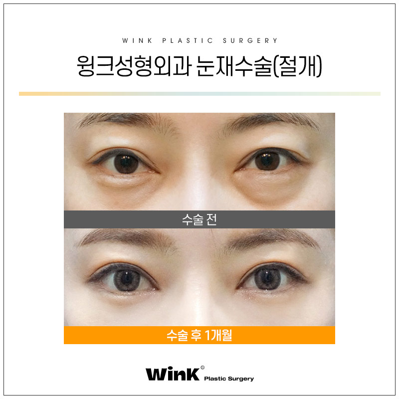 윙크성형외과에서 알려드리는 눈성형의 모든것! 관련 이미지 5