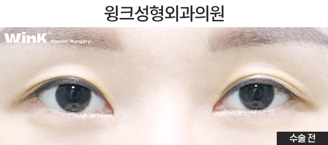 What Kind of Double Eyelids Suit Deep-Set Eyes? image 5