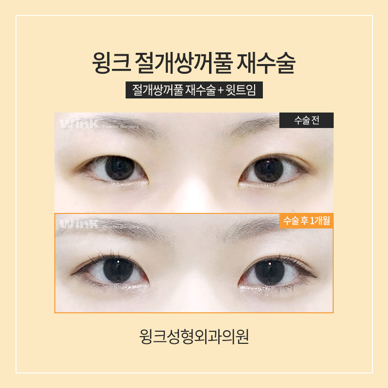 절개 쌍수 재수술에 대해 알아보겠습니다. 관련 이미지 3