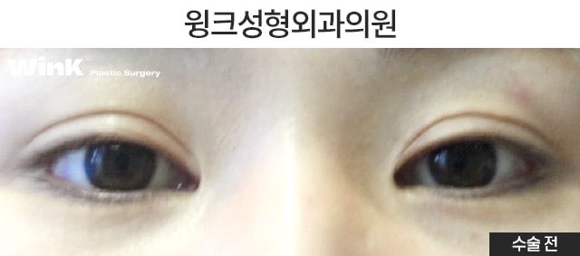 듀얼트임으로 자연스럽게 눈을 키우는 방법에 대해 알아볼까요? 관련 이미지 5