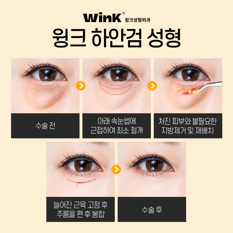 Lower Eyelid Surgery at Wink Plastic Surgery for Bulging, Wrinkled Under-Eyes image 4
