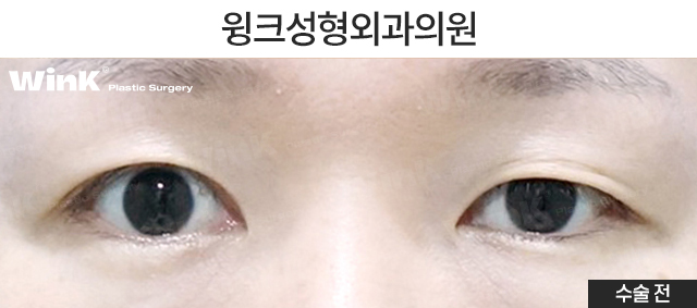 비대칭 안검하수 눈매교정은 어떻게 하는 것일까? 관련 이미지 2