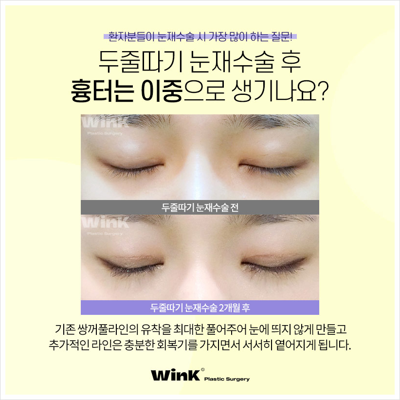 쌍꺼풀재수술 두줄따기눈재수술 윙크성형외과 소세지눈재수술 관련 이미지 5