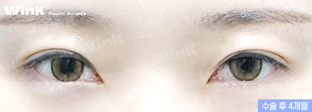 Lowering the Double Eyelid Line: Making Thick Double Eyelids (Sausage Eyes) Look Natural with a Two-Line Revision Surgery! image 3