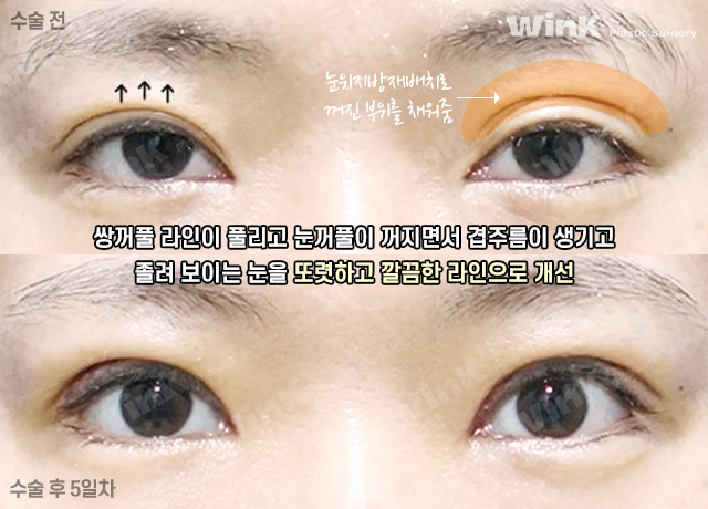 마지막 눈 성형, 눈매교정으로 또렷하게 개선해 드리는 윙크성형외과 눈재수술! 관련 이미지 4