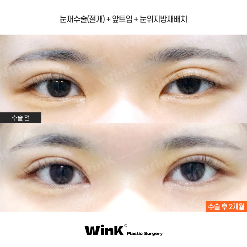 Wink Plastic Surgery Double Eyelid Revision Surgery, Pursuing Natural Results by Identifying the Exact Cause of Failure image 1