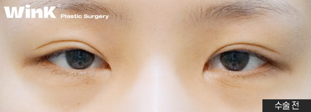 Wink Canthoplasty That Gently Lifts for a More Defined, Clear Eye Shape! image 4