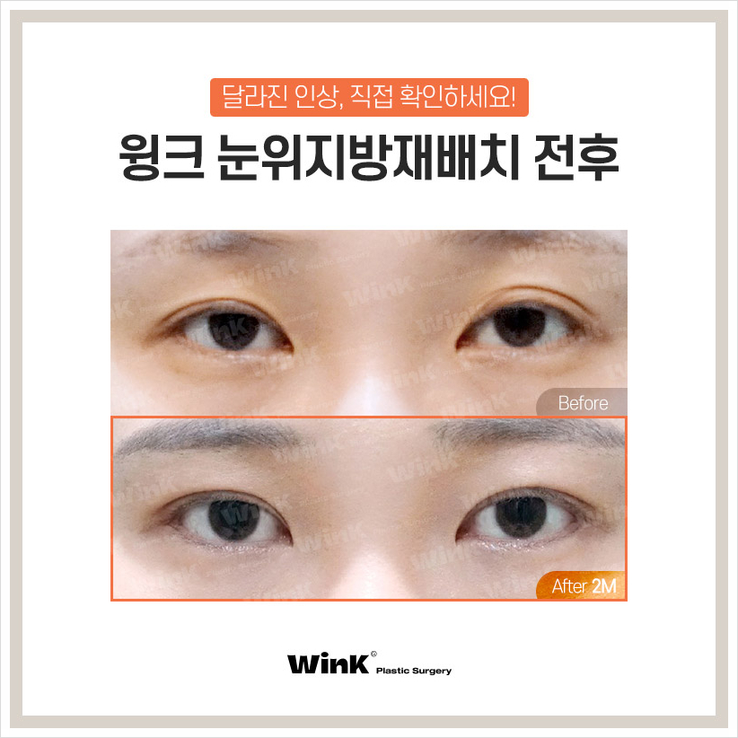 Wink Plastic Surgery Upper Eyelid Fat Repositioning Sleepy Eye Surgery Sinsa Sunken Eye Fat Grafting image 7