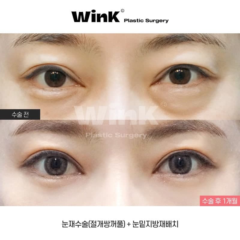 눈재수술 이런분들께 추천드립니다! 관련 이미지 1