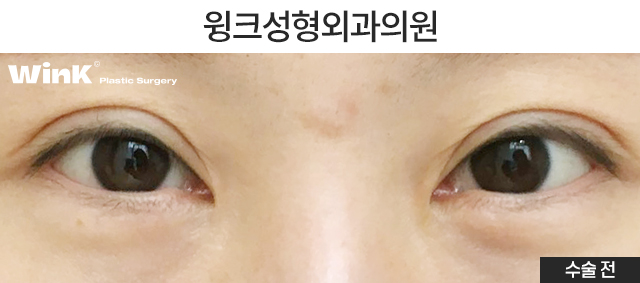 Can Medial Epicanthoplasty Revision and Incisional Double Eyelid Revision Be Done at the Same Time? image 2
