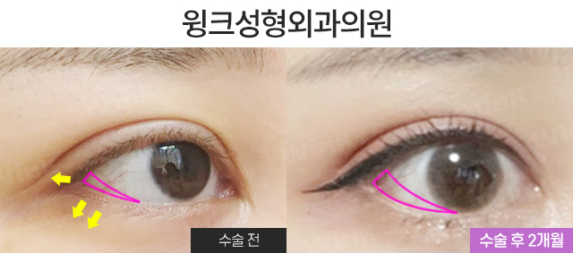 Make a Fierce Eye Shape Look Gentle with Outer and Lower Corner Eye Surgery! image 7