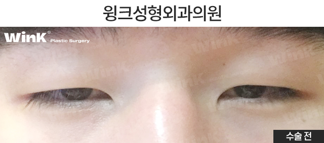 남자 속쌍커풀 수술에 대해 알아보자 관련 이미지 2