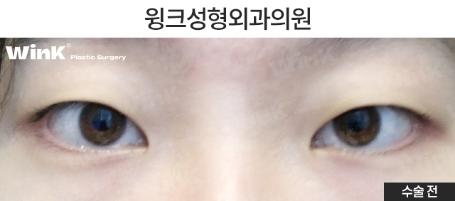 남자 속쌍커풀 수술에 대해 알아보자 관련 이미지 5
