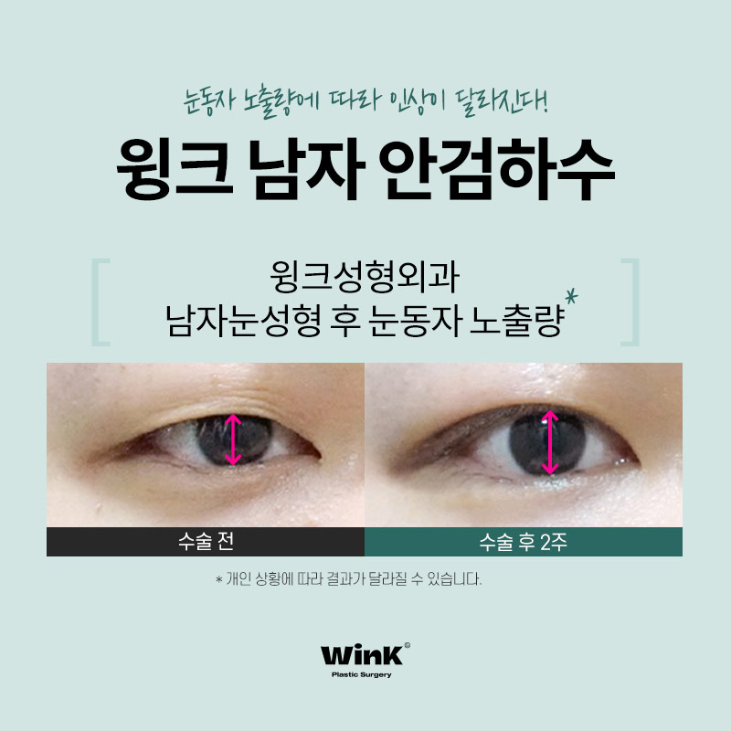 남자안검하수후기 안검하수교정 윙크성형외과 남자눈매교정수술전후 관련 이미지 5