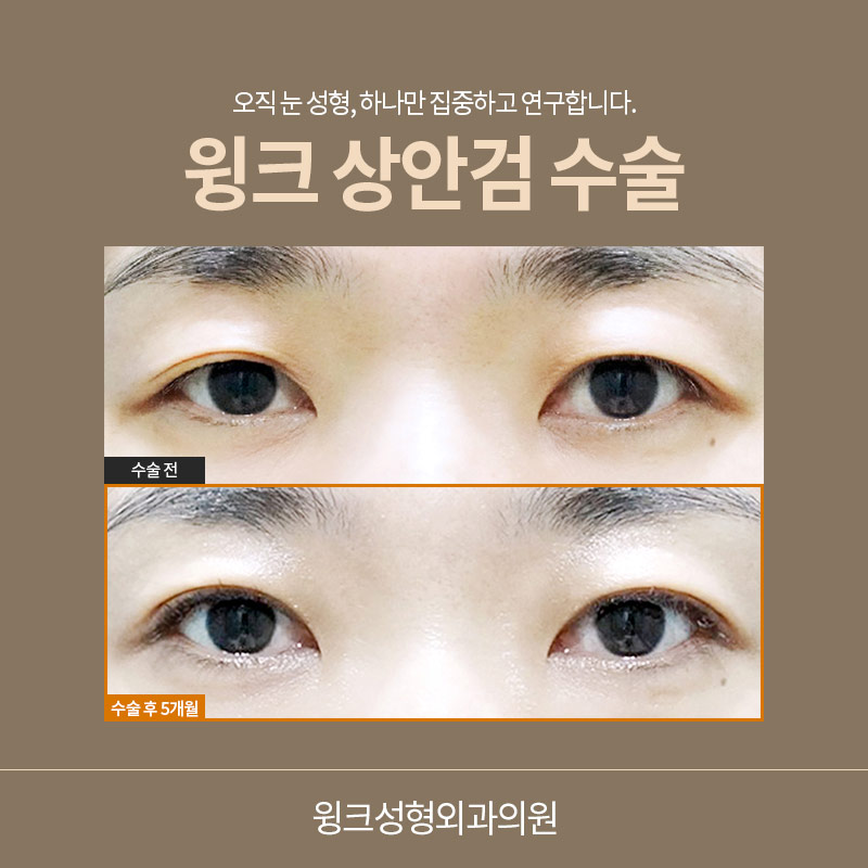 If You Want Upper Eyelid Surgery to Look Natural image 3