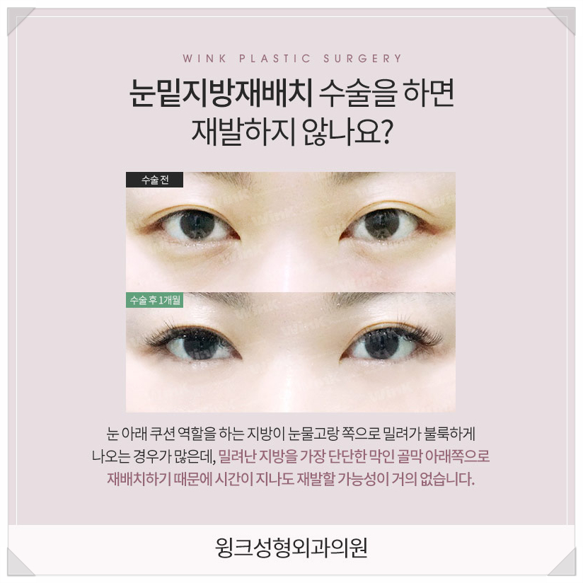 눈밑지방재배치가격좋은곳 눈밑지방재배치병원 눈밑지후기 찾는다면 윙크성형외과 관련 이미지 7