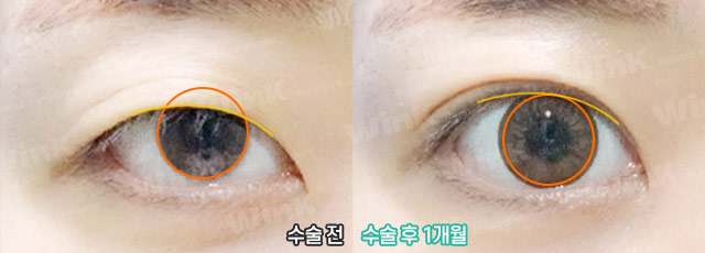 적절한 눈동자 노출로 더욱더 또렷한 눈매로! 관련 이미지 5