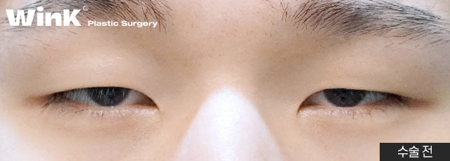 Monolid, inner double eyelid, or outer double eyelid? Choose the line that suits you! Men’s eye surgery at Wink Plastic Surgery image 4