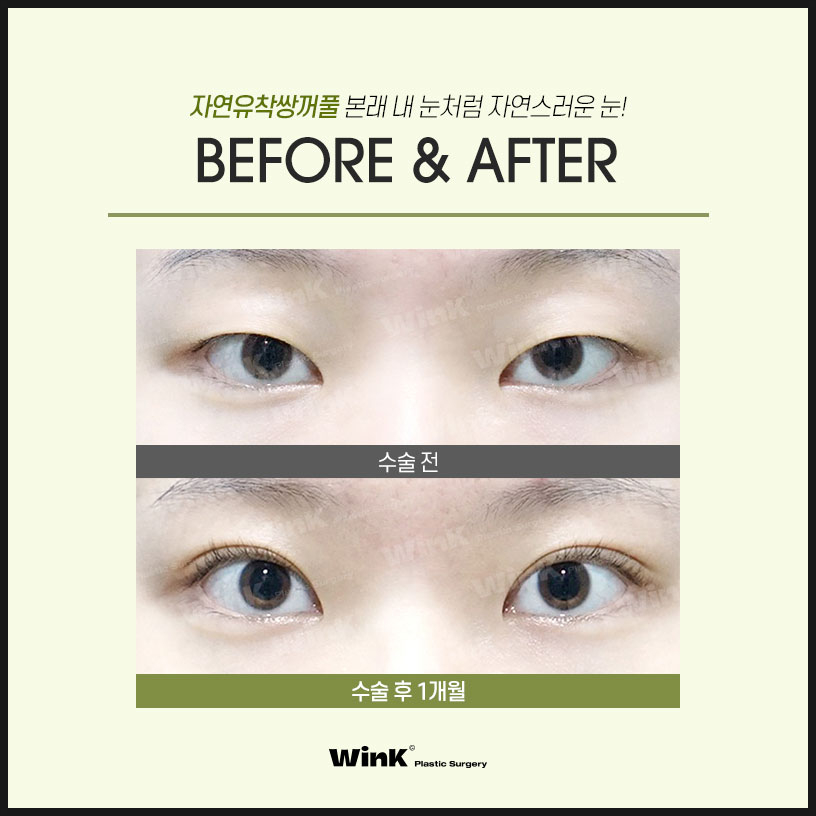 쌍수자연유착의 모든것 윙크에서 알려드려요 자연유착쌍꺼풀후기 쌍꺼풀수술잘하는곳 관련 이미지 7
