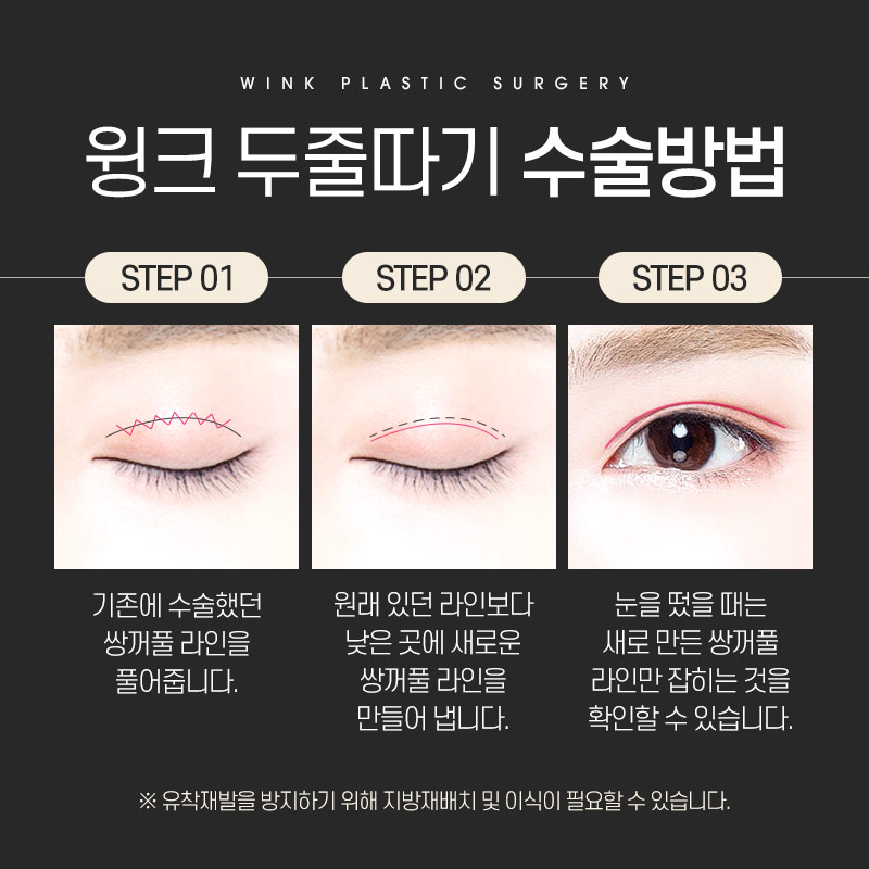 절제 없이 눈재수술 하고 싶다면? 윙크성형외과 두줄따기 눈재수술 관련 이미지 3