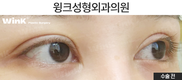 Make a Fierce Eye Shape Look Gentle with Outer and Lower Corner Eye Surgery! image 5