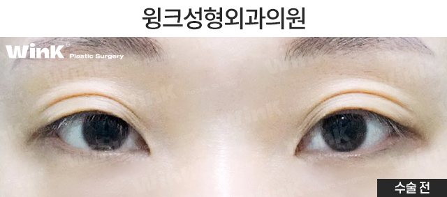 Let’s Take a Look at the Changes and Effects Before and After Upper Epicanthoplasty image 5