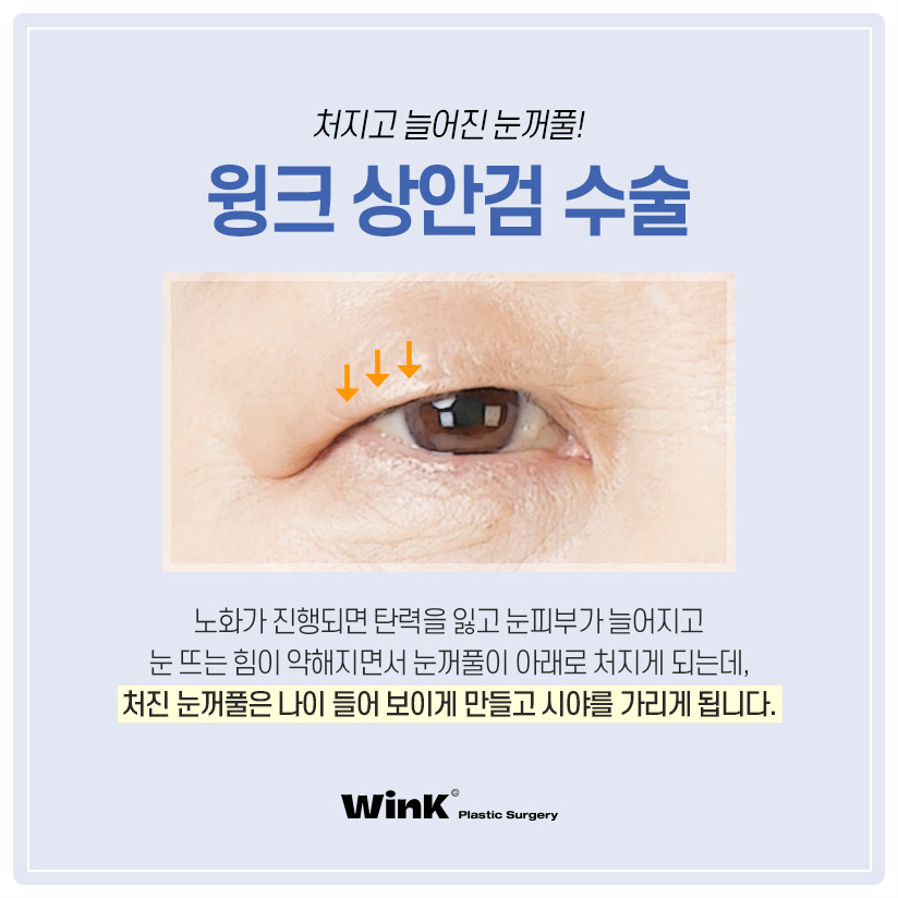 If You’re Looking Into Droopy Eyelid Surgery, Wink Plastic Surgery Upper Blepharoplasty and the Best Place for Upper Eyelid Surgery image 3