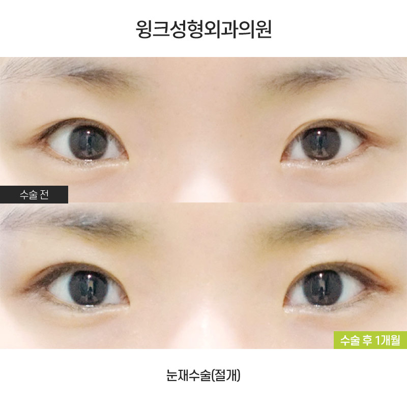 How Should Double Eyelid Surgery Be Performed for Small, Narrow Eyes? image 1