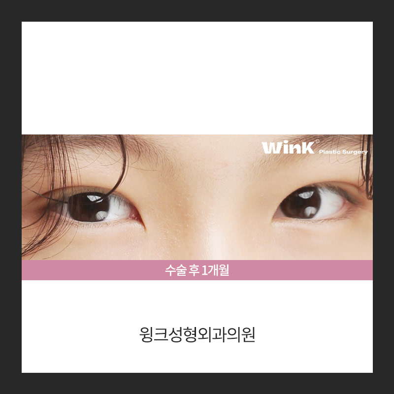 자연유착 쌍꺼풀 수술에 대해 알아보겠습니다. 관련 이미지 5
