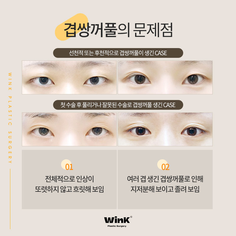 윙크성형외과에서 알려드리는 겹쌍꺼풀과 눈 뜨는 힘이 중요한 이유! 관련 이미지 3